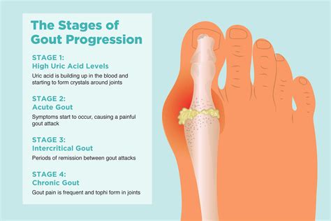 Gout .